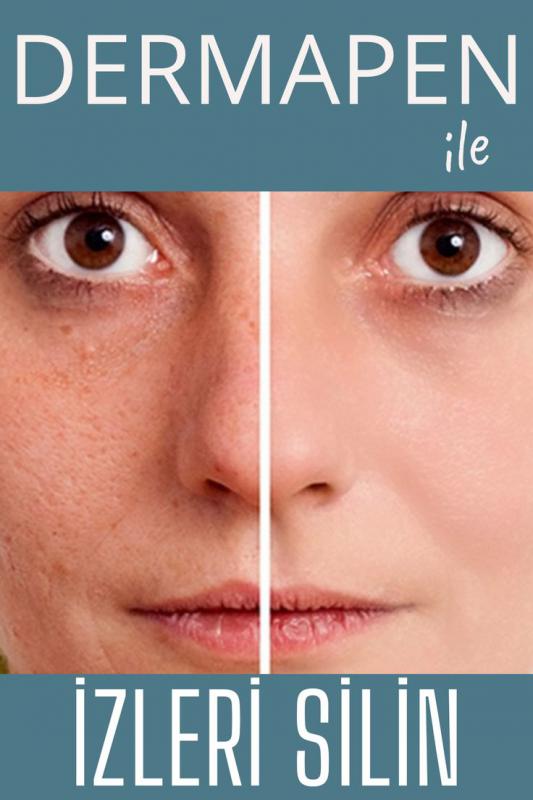 Dermapen ile Leke ve İz Tedavisi